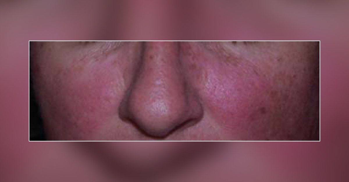 A Young Woman with Butterfly Rashes and Joint Pain